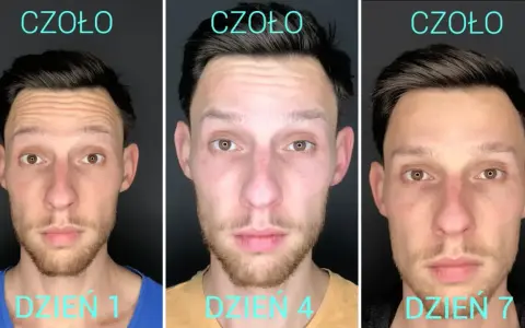 Trzy zdjęcia mężczyzny pokazujące efekt botoksu na czoło: dzień 1 (zmarszczki), dzień 4 (zmniejszone zmarszczki), dzień 7 (gładkie czoło).