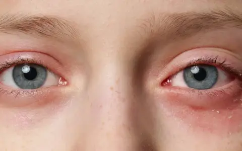 Nahaufnahme der Augen eines Kindes mit geröteten, gereizten Augenlidern und einem leichten Ausschlag unterm Auge.