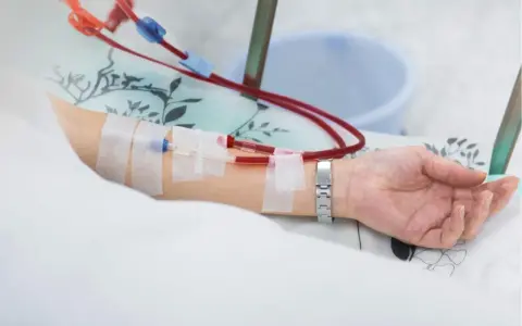 Ramię pacjenta z założonym cewnikiem Sheldona, podłączonym do aparatury dializacyjnej.