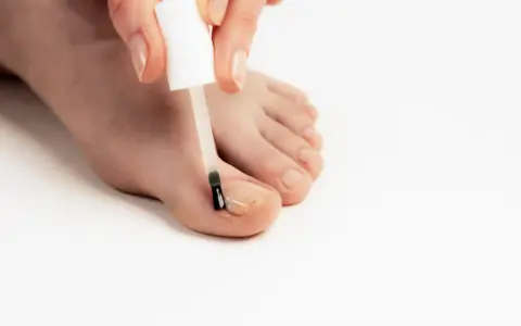 Application d'une huile essentielle sur un ongle incarné pour soulager la douleur et favoriser la guérison.