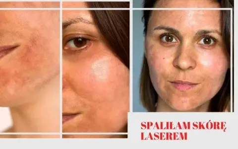 Jak długo goi się skóra po laserze frakcyjnym? Czas regeneracji