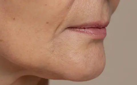 Primer plano de la zona de la barbilla y boca, mostrando la flacidez facial a los 40 y algunas pecas.