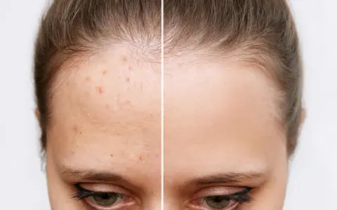 Avant/après : peau acnéique transformée en peau nette. Découvrez par quoi remplacer l'acide salicylique pour une peau parfaite.