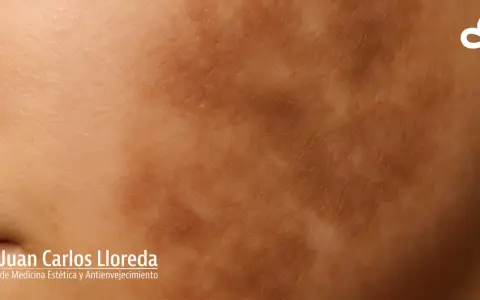 Piel con manchas irregulares, indicativo de hiperpigmentación postinflamatoria.