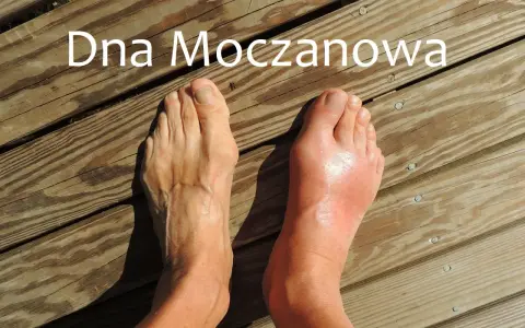 Dna moczanowa: obrzęknięty, czerwony paluch stopy po prawej, zdrowa stopa po lewej. Przyczyny tej choroby mogą być różne.