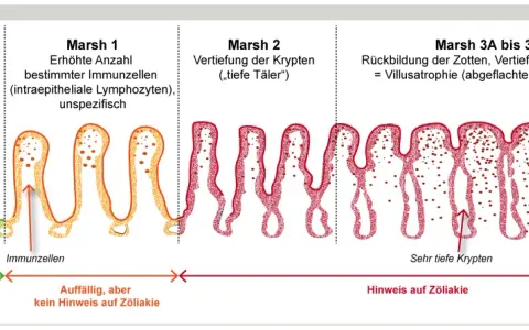 Darstellung der Marsh-Klassifikation von Zöliakie: Von gesunder Schleimhaut (Marsh 0) über Entzündung (Marsh 1-2) bis zur Zottenatrophie (Marsh 3), die bei einer **Haferallergie** auftreten kann.