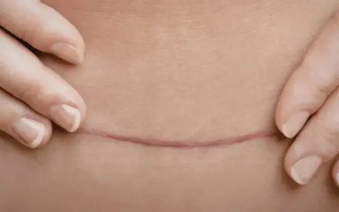 Dłonie delikatnie odsłaniają poziomą bliznę po cesarskim cięciu, przypominającą pionowy labret blizna.