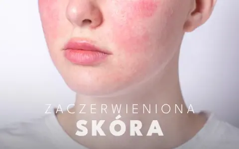 Widoczne zaczerwienienie na policzkach, które pokazuje, jak wygląda rumień. Skóra jest podrażniona i zaczerwieniona.
