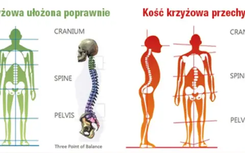 Prawidłowe ułożenie kości krzyżowej zapewnia stabilność kręgosłupa. Po prawej widać skrzywienie, gdzie kość krzyżowa jest przechylona.