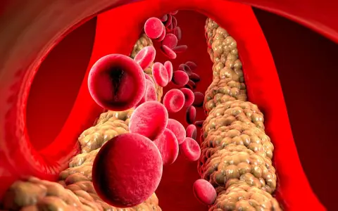 Wysoki cholesterol: Czy masz te objawy? Sprawdź, zanim będzie za późno.