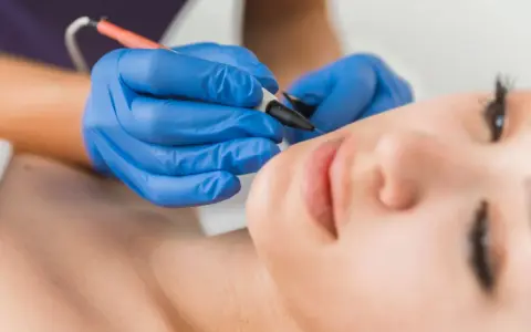 Zabieg trwałej depilacji twarzy. Kosmetolog w niebieskich rękawiczkach wykonuje precyzyjny zabieg.