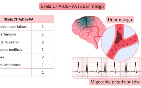 Tabela CHA2DS2-VA, schemat mózgu z udarem, naczynie krwionośne z zakrzepem i EKG.