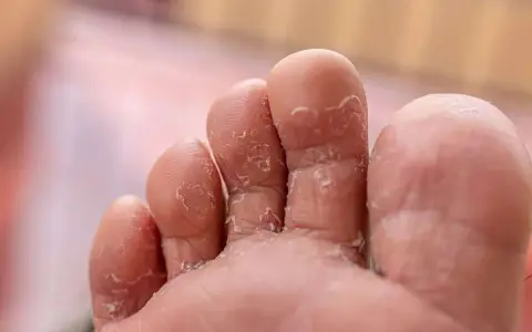 Close-up of toes with peeling skin, a common symptom of athlete's foot. Many wonder if Epsom salt is good for athlete's foot.
