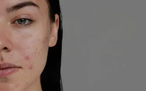 Primo piano del viso di una giovane donna con brufoli e rossori. L'acido ialuronico può aiutare a migliorare l'aspetto della pelle.