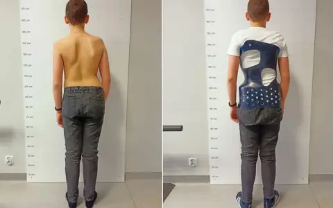 Chłopiec w gorsecie na kręgosłup, korygującym wadę postawy. Widoczna poprawa sylwetki.