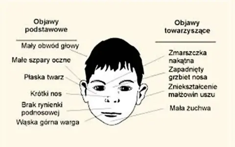 Ilustracja twarzy dziecka z opisem objawów. Co to znaczy? Mały obwód głowy, płaska twarz, krótki nos, wąska warga, zmarszczka nakątna, zapadnięty grzbiet nosa.