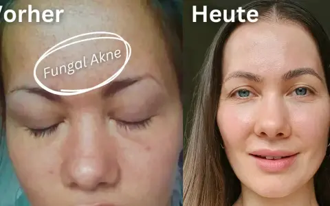 Vorher: Haut mit Rötungen und Pickelchen, gekennzeichnet als "Fungal Akne". Heute: Klare, strahlende Haut.