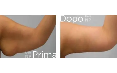 Prima e dopo liposuzione braccia: un braccio più tonico e definito.