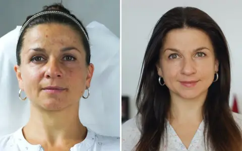 Przed i po zabiegu: skóra z niedoskonałościami i przebarwieniami staje się gładka i promienna. Fibryna pod oczy zdziałała cuda!