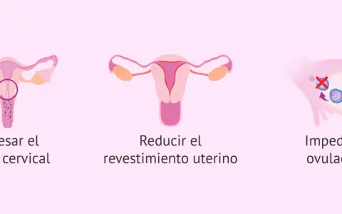 Ilustración de métodos anticonceptivos: espesa el moco cervical, reduce el revestimiento uterino e impide la ovulación. El diu en España es una opción.