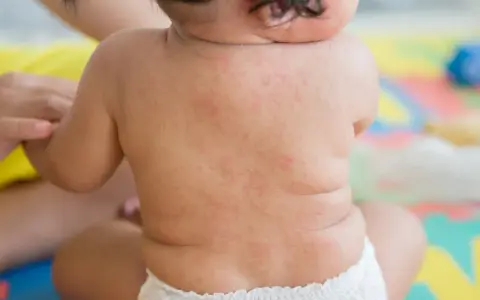 Roter Ausschlag auf dem Rücken eines Babys, möglicherweise nach drei Tagen Fieber.