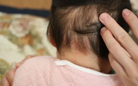 Dita accarezzano la nuca di un neonato, dove si notano delle piccole macchie rosse, quasi un "morso della cicogna" che porta con sé storie di nascita.