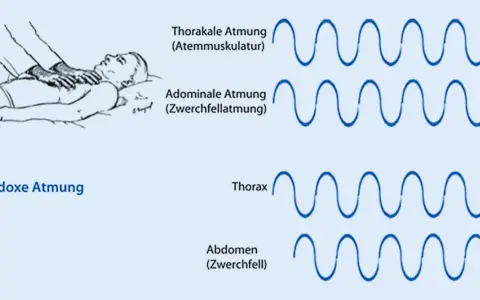 Illustration zeigt paradoxe Atmung. Die MRC Skala hilft, die Atmungsmuster zu verstehen: Thorakale vs. Abdominale Atmung und die paradoxe Bewegung von Thorax und Abdomen.