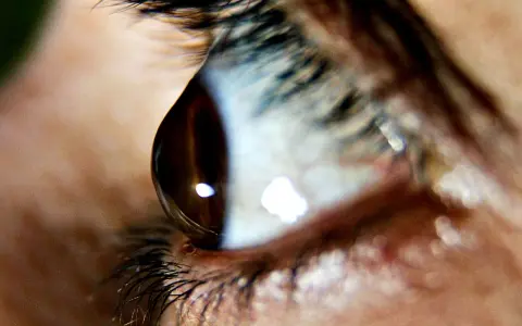 Occhio umano con riflessi luminosi. Il cheratocono è ereditario, una condizione che può colpire la vista.