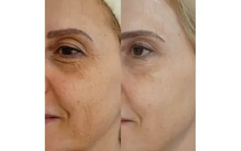 Vorher-nachher-Vergleich der Haut einer Frau: Deutliche Reduzierung von Falten und Pigmentflecken nach Anwendung von Retinol.