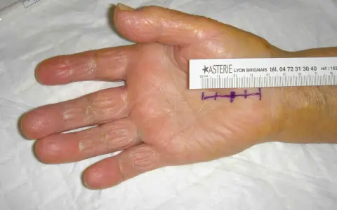 Main de patiente avec marques violettes et règle millimétrée, indiquant la zone d'intervention pour un syndrome du canal carpien.
