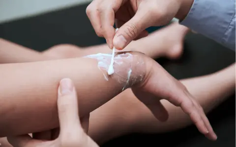 Delikatne smarowanie oparzonej skóry kremem na oparzenia za pomocą patyczka kosmetycznego.