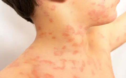Primer plano de sarpullidos en la piel de un niño, con manchas rojas y elevadas en el cuello y el hombro.