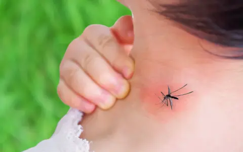 Dziecko drapie zaczerwienione miejsce na szyi po ukąszeniu komara. Rumień jest widoczny.