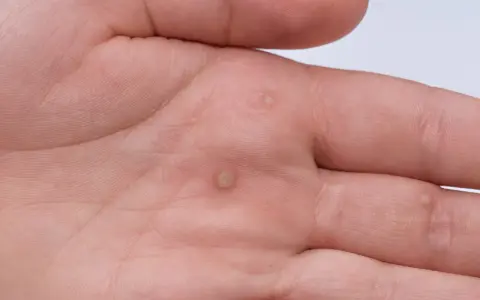 Dłoń mężczyzny z kilkoma brodawkami, które mogą być objawem wirusa HPV. Widoczne zmiany skórne na wewnętrznej stronie dłoni.