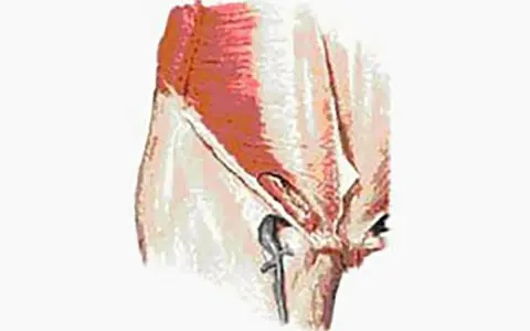 Illustration anatomique montrant la région pubienne, pertinente pour la pubalgie chez la femme.