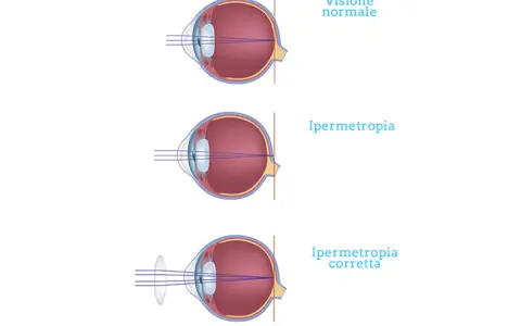 Illustrazione dell'ipermetropia oculare: visione normale, ipermetropia e correzione con lente.