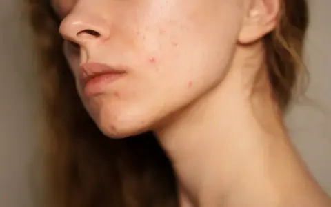 Visage d'une jeune femme avec des rougeurs et des marques de cicatrice acné sur la joue et le menton.