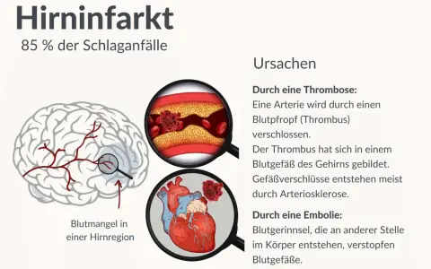 Illustration zeigt Hirninfarkt, Ursachen wie Thrombose/Embolie und Blutarmut in Hirnregion. Der demenz nach schlaganfall verlauf kann hier beginnen.