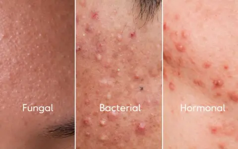 Comparación de tipos de acné: Fungal, con pequeños bultos; Bacterial, con pústulas y granos; Hormonal, con rojeces y protuberancias.