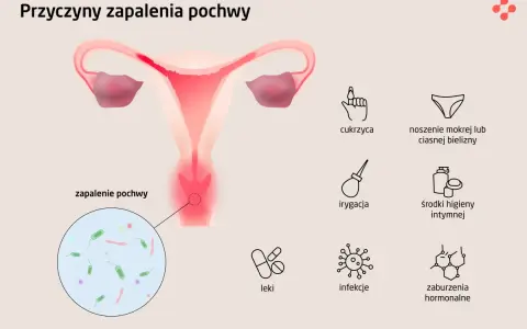 Ilustracja przedstawia przyczyny zapalenia pochwy: cukrzyca, noszenie mokrej bielizny, irygacja, środki higieny intymnej, leki, infekcje, zaburzenia hormonalne.