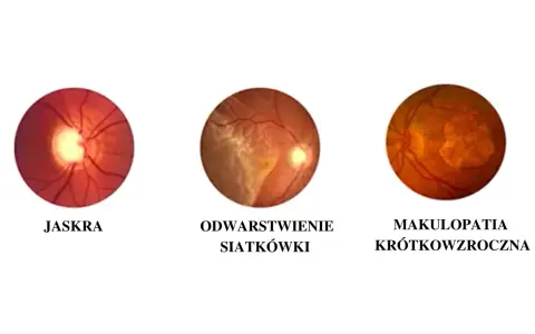 Krótkowzroczność: Jak zatrzymać postęp wady i odzyskać ostry wzrok?