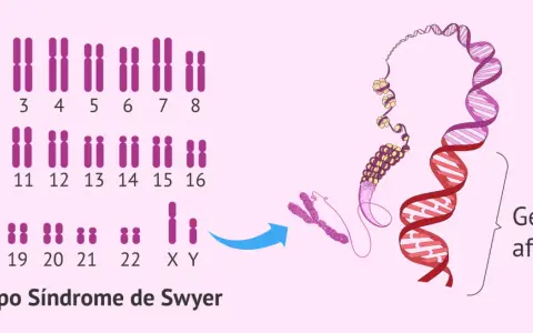 Cariotipo XY con el gen SRY afectado, indicativo del Síndrome de Swyer.