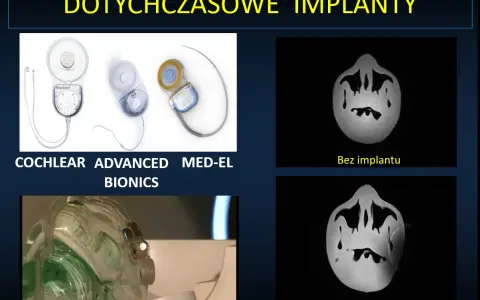 Nowoczesne implanty ślimakowe, w tym niewidoczny implant, poprawiają słuch.