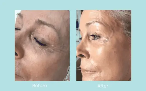 Before and after images show a woman's face. The "before" side displays dehydrated, dull skin with visible wrinkles. The "after" side reveals plump, hydrated, and radiant skin.