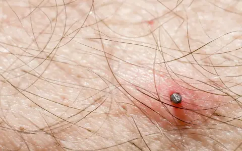 Rumień po kleszczu: borelioza czy alergia? Rozpoznaj i działaj!