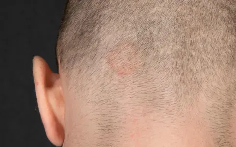 Rötlicher, ringförmiger Hautausschlag am Kopf, möglicherweise tinea corporis.