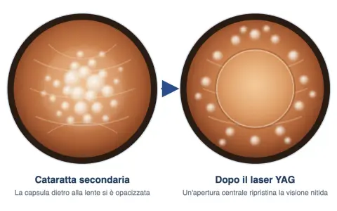 Prima e dopo il laser YAG: la capsula opacizzata della cataratta secondaria viene trattata con un barrage laser retina per ripristinare la visione nitida.