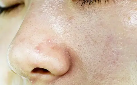 Fettige Gesichtshaut: Ursachen, Pflege und Tipps für klare Haut