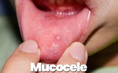 Piccolo mucocele sulle labbra, una piccola cisti piena di liquido che può comparire all'interno della bocca.