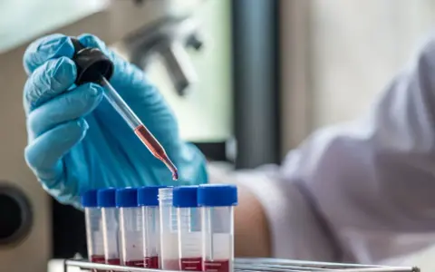 Laborant pobiera próbkę krwi do analizy. Dowiedz się, ile kosztuje test na HIV w laboratorium.